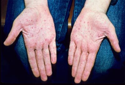 Psoriasis